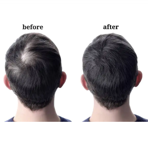 Natural Hair Loss Remedy